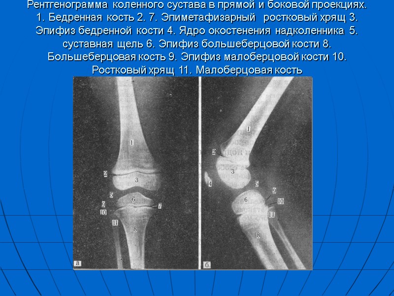 Рентгенограмма коленного сустава в прямой и боковой проекциях. 1. Бедренная кость 2. 7. Эпиметафизарный